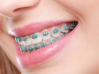 Benefits of Dental Braces